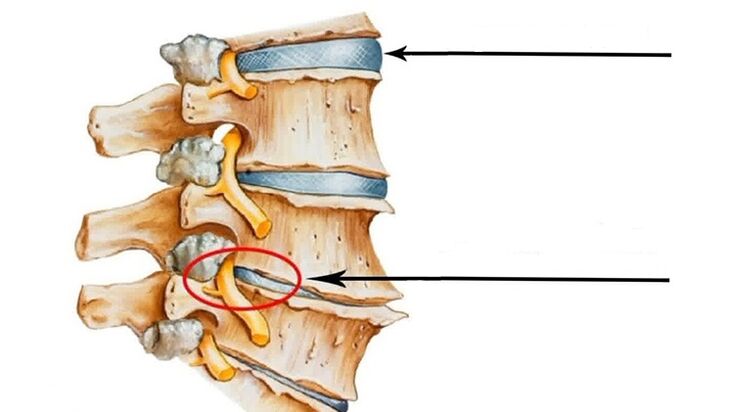 повреда на 'рбетот во случај на цервикална остеохондроза