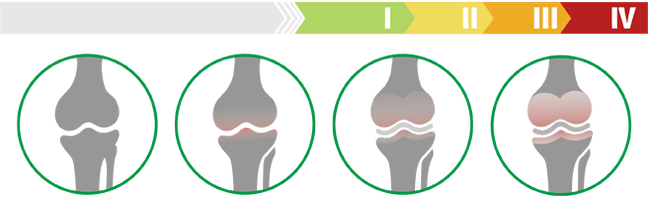 Клинички фази на артроза на коленото зглоб (степен на артроза на коленото зглоб)