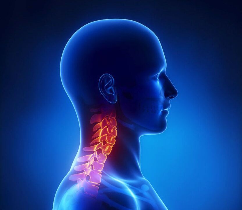 Цервикалната остеохондроза е патологија на 'рбетот, од која можете да се ослободите дома