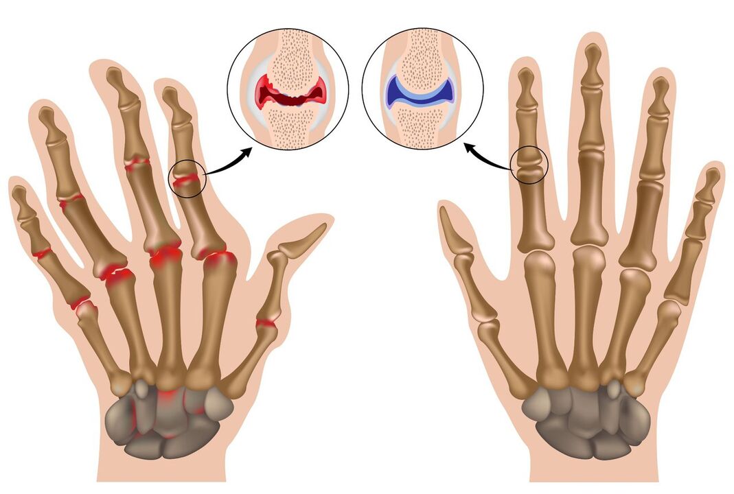 Здрави и зглобови на рацете погодени од полиартритис